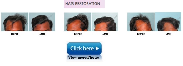HAIR RESTORATION